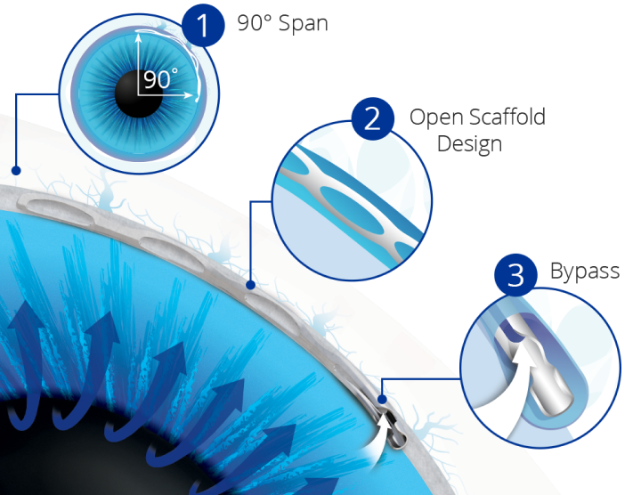 An up-close image of the Hydrus Microstent implanted in an eye. Dark blue arrows indicate flow travelling through the device. Three circular images numbered one through three point to various locations on the device in the eye. The magnified image in number one indicates a 90º Span, number two indicates Open Scaffold Design, and number three indicates Bypass.