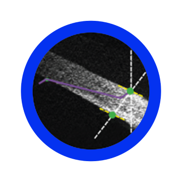 More accurate, more efficient, and less damaging self-sealing cataract incision in terms of architecture, size and geometry6