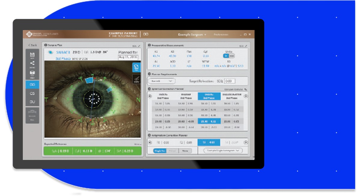 Digital surgical planning screen showing a close-up of a patient’s eye with overlays for astigmatism correction and cataract surgery parameters