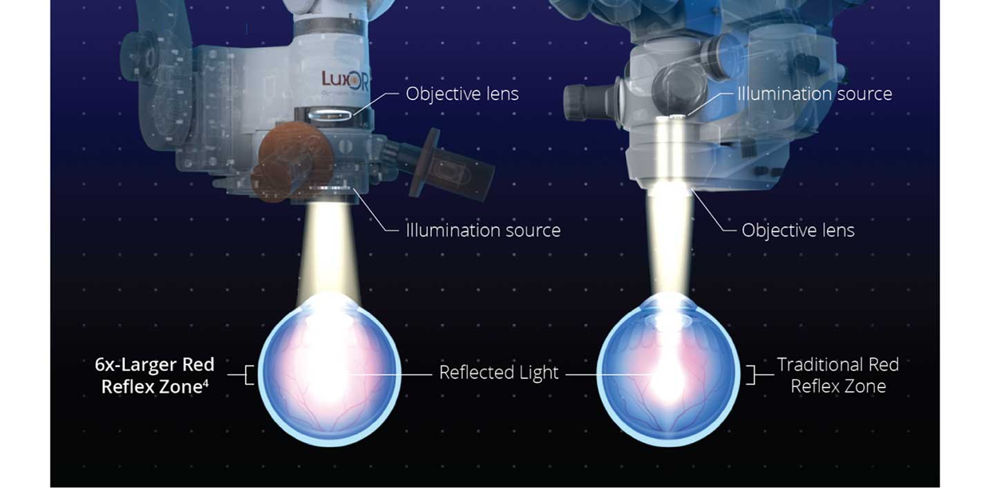 Comparison of LuxOR and traditional microscopes showing larger vs. smaller red reflex zones on the eye.