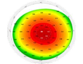 A corneal topography map displaying color-coded data with red, yellow, and green zones, illustrating variations in corneal curvature and elevation for diagnostic purposes.