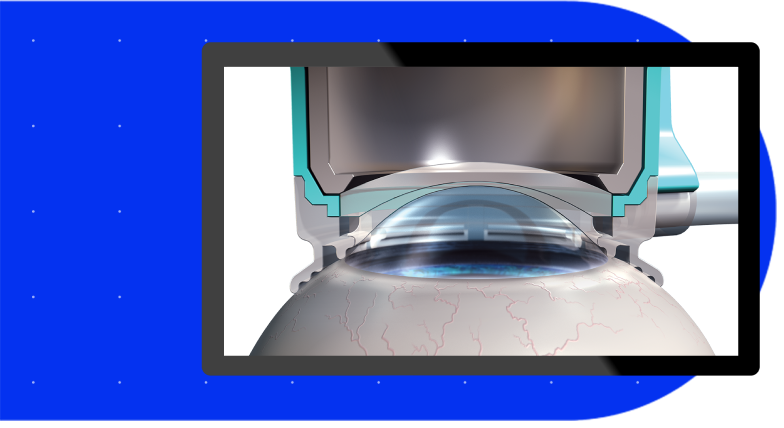 The SoftFit® Patient Interface –Experience greater precision
with the hydrogel lens insert of
the LenSx® Laser.
