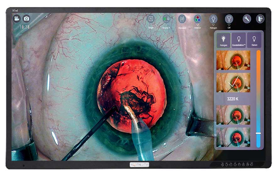 Intraoperative digital view of an eye during cataract surgery, showing a red reflex through the pupil with ophthalmic surgical instruments positioned in the anterior chamber, surrounded by a green-tinted cornea and displayed within a surgical visualization system interface with multiple filtered image thumbnails on the right.