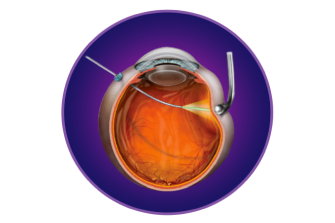 Illustration of a VEKTOR Laser probe going through an eyeball.