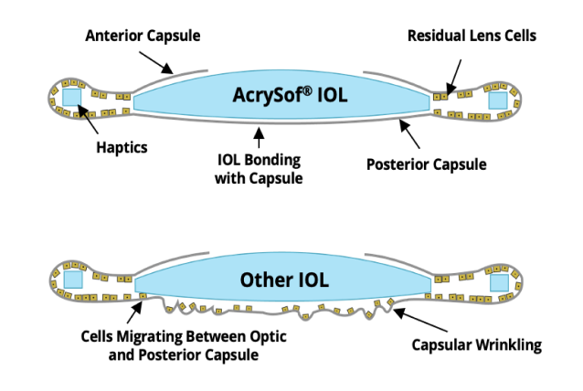 2 illustrations. The first one shows the AcrySof IOL bonded with the posterior capsul with not cell migration. The second illustration shows other IOLs with cells migrating between the optic and posterior capsule.