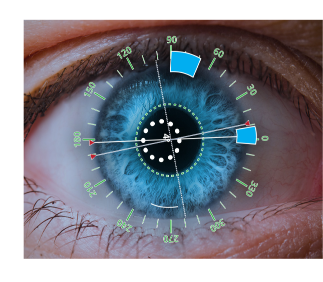 An image of an eye close up with a digital overlay showing angles and incision locations.